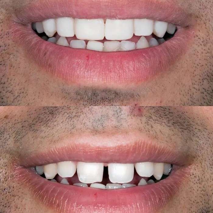 Cosmetic Dentistry Treatment