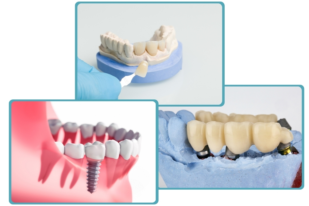 Image presents Dental Crowns & Bridges vs. Dental Implants Which is Right for You