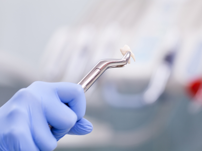 extracted molar held by dentist after emergency tooth extractions